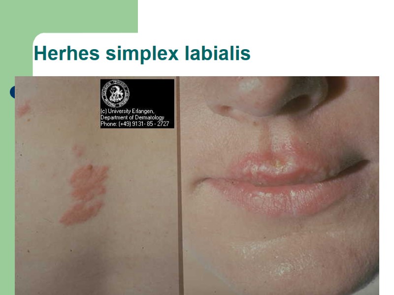 Herhes simplex labialis